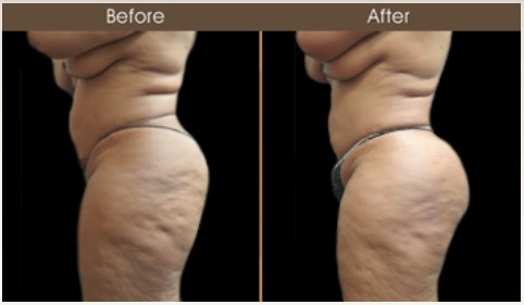 Gluteal Fat Grafting Before And After